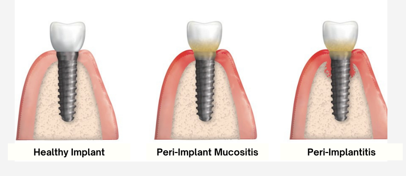 Peri-Implant Disease