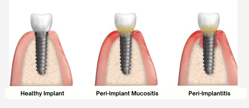 PERI-IMPLANT DISEASE