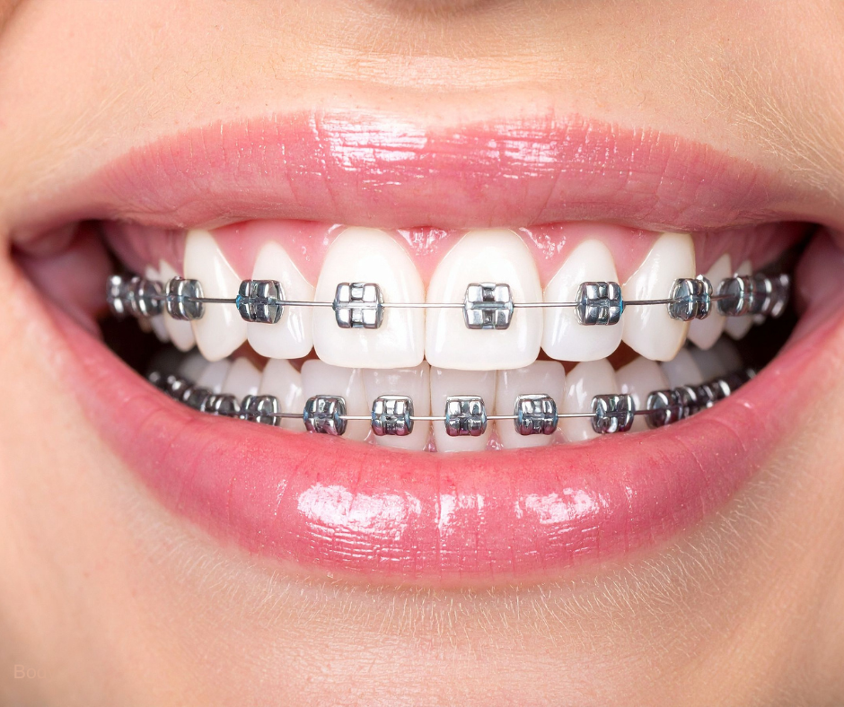 Why People with Braces Love the Hydro Floss® Oral Irrigator