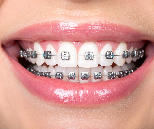 Why People with Braces Love the Hydro Floss® Oral Irrigator