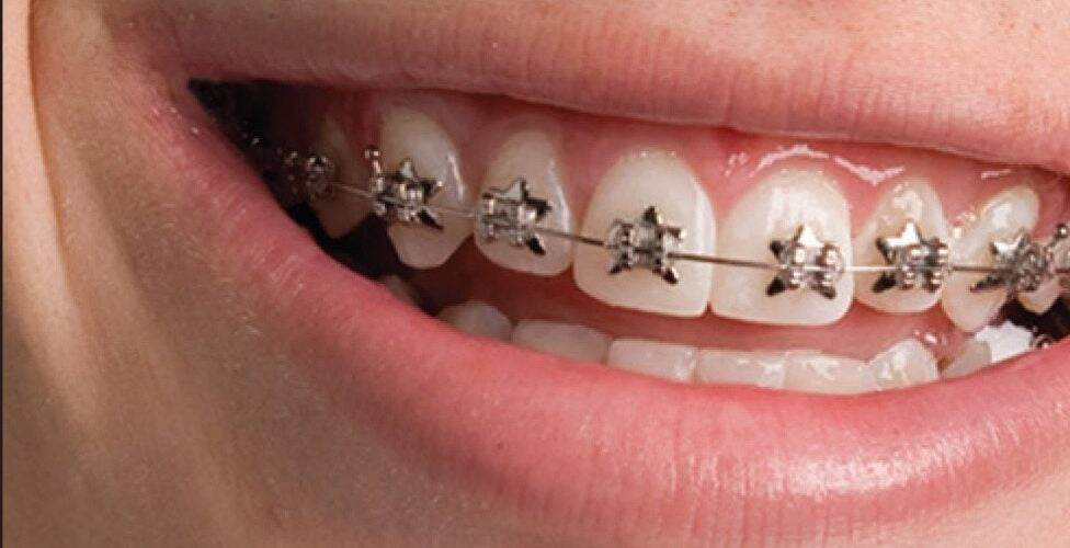 Orthodontic Appliance Care