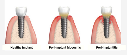 PERI-IMPLANT DISEASE