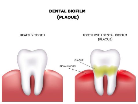 DENTAL PLAQUE:  What it is and why it is important to remove it from your teeth